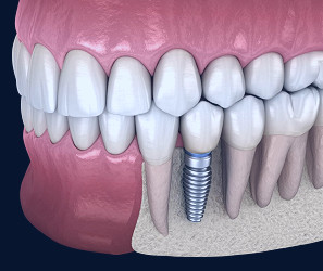 How Much Do Dental Implants Cost in Midtown NYC?